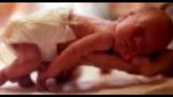 fetal alcohol syndrome