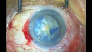 Phacoemulsification, lens trauma after IVI of antiVEGF, Double anterior lens capsule