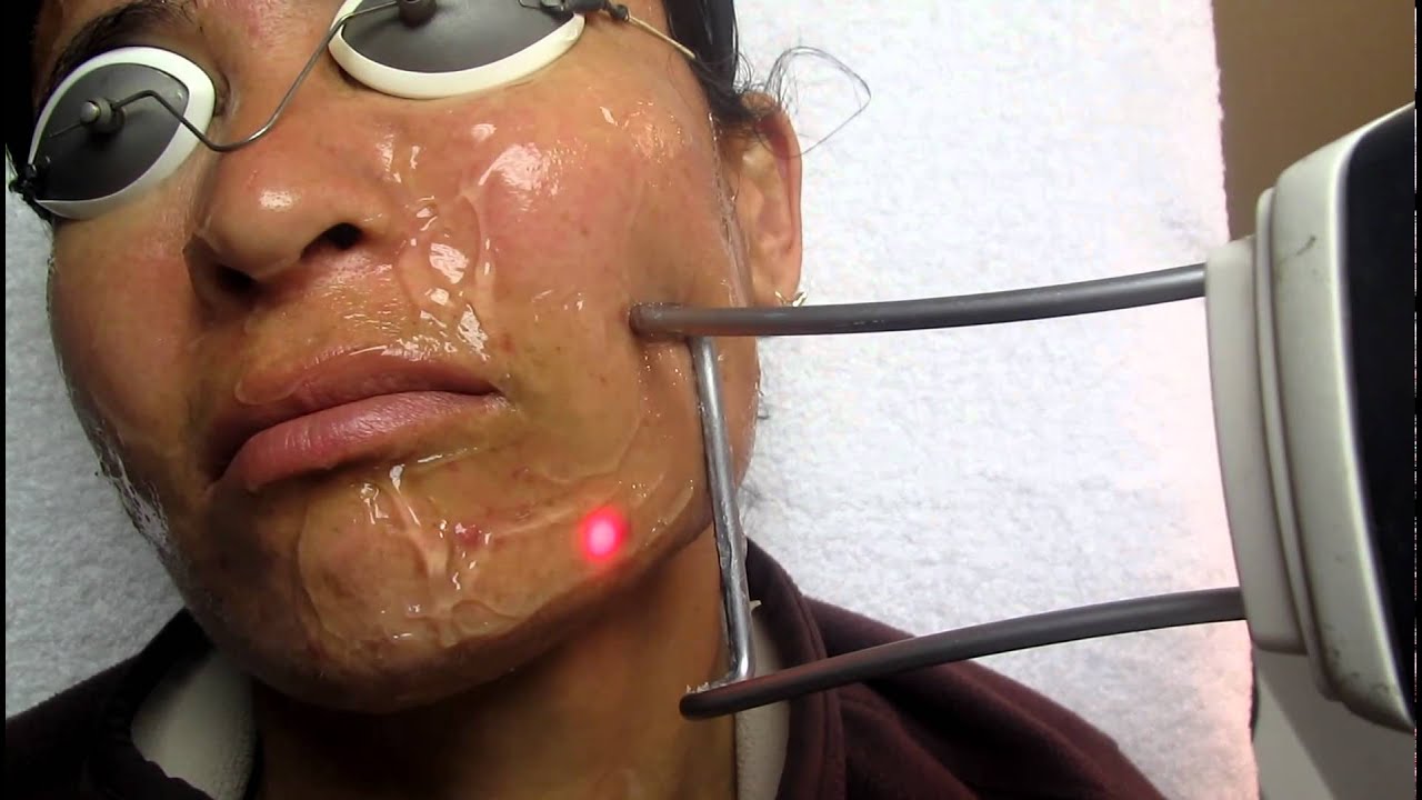 Laser Hair Removal with Fotona Laser in Los Angeles ,Orange County and