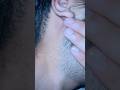 #ingrownhairremoval #removeingrown #asmr#asmrhair#satisfying #oddlysatisfying #viralshort