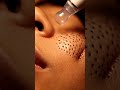 Cheek Blackhead Vacuum ASMR – Ultimate Satisfaction #satisfying #blackheadcaique #skincare #macroasm