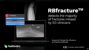 Radiobotics — About RBfracture™