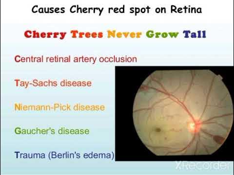 Cherry-Red Spot in Tay–Sachs Disease