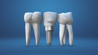 Animation of the dental implants stock footage | stock video | Cinefootage
