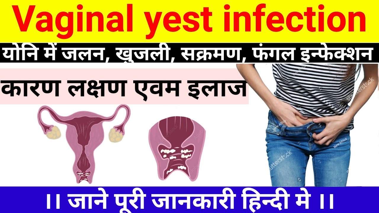 योनि में जलन, खुजली, सफेद पानी के कारण vaginal fungal infectioncause,symptoms & treatment in