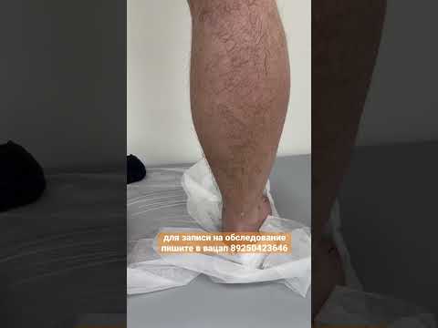 Варикоз у парня. Лечение варикоза, планируем операцию. Сосудистый хирург. Флеболог Москва. Флеболог