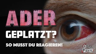 Wie gefährlich sind geplatzte Adern im Auge? (Augenoptiker erklärt)