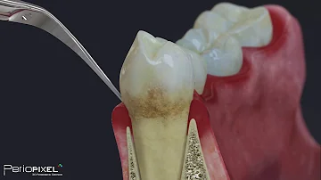 ¿Necesita mantenimiento periodontal para siempre?