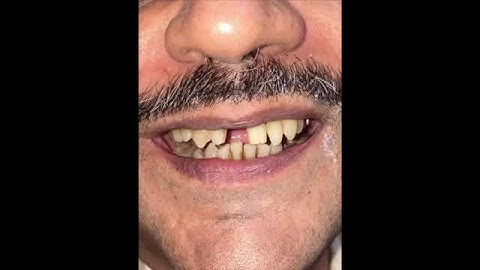 Smile reconstruction with porcelain bridge #dentalbridge #veneers #satisfying #smilemakeover #teeth