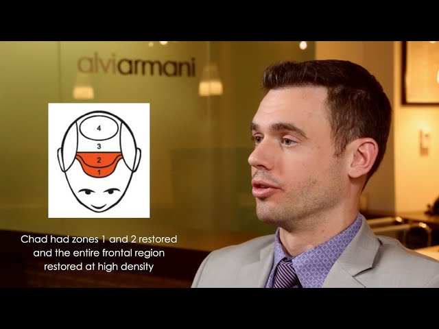 Hair Transplant Consultant Testimonial - Alvi Armani - Beverly Hills