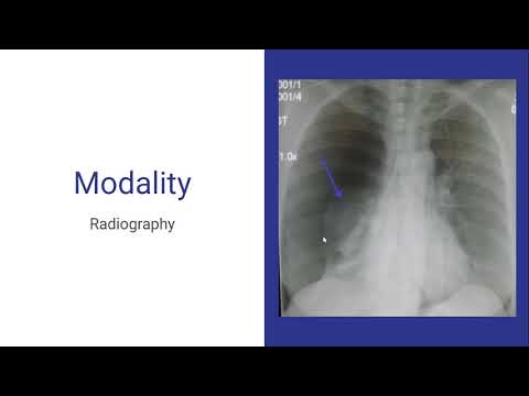 Introduction to Pneumothorax Segmentation Challenge