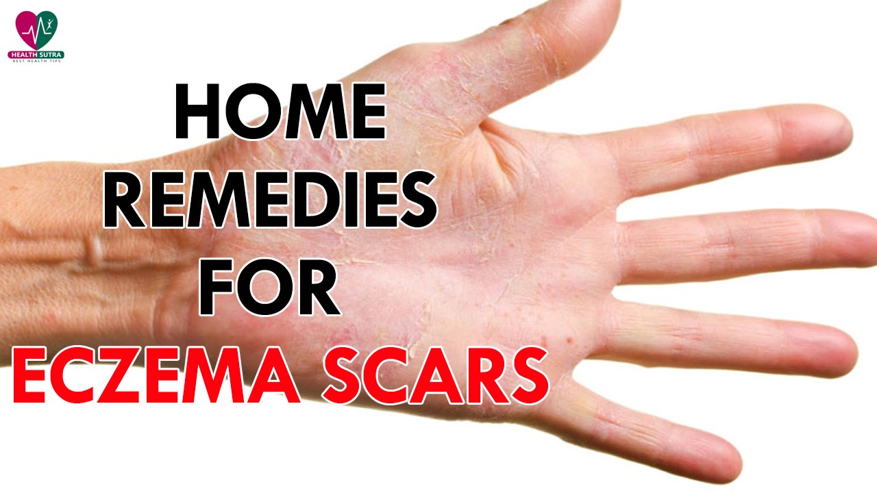 home remedies for eczema scars health sutra youtube