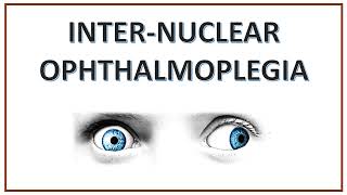 Internuclear Ophthalmoplegia | INO | WEBINO Syndrome | One and Half Syndrome