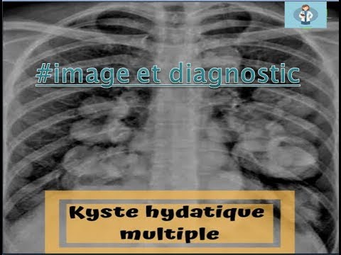 Vidéo: Imagerie Amyloïde Dans Le Diagnostic Différentiel De La Démence: Revue Et Applications Cliniques Potentielles