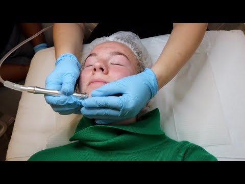 Video: Microdermabrasie Voor Acnelittekens: Voordelen, Bijwerkingen En Kosten