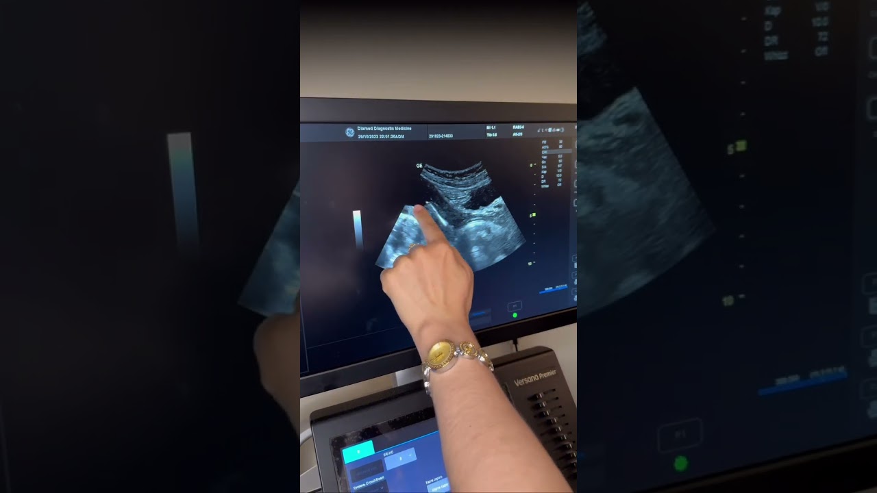 Speral ustidan xomiladorlik