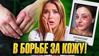 КАК С ЭТИМ ЖИТЬ? | Зависимость от гормонов | атопический дерматит