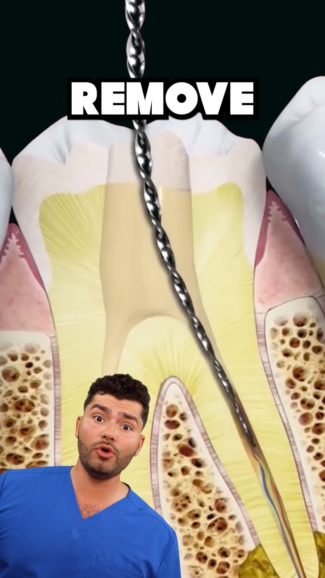 Root Canal Explained !?