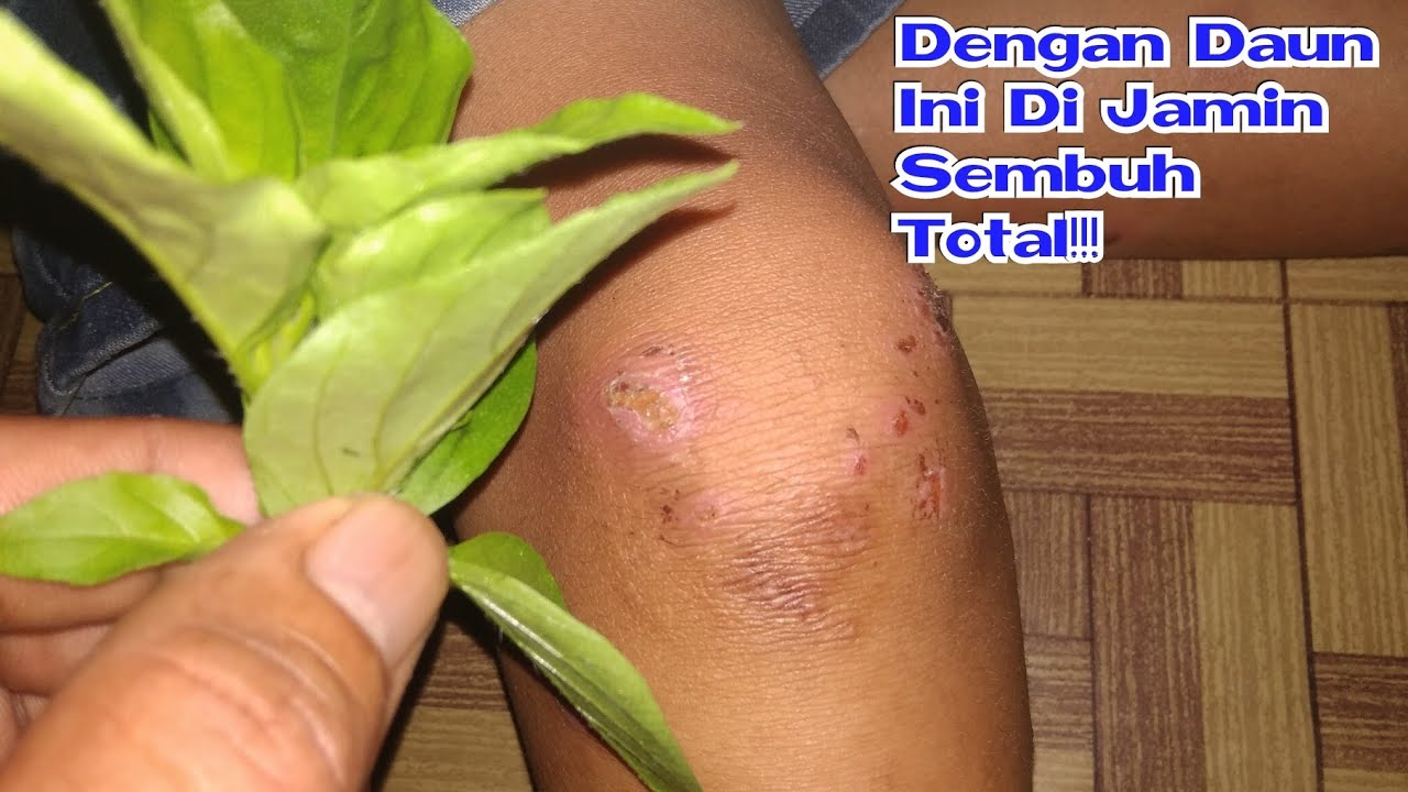 Cara Unik Mengatasi Gatal Alergi Di Kulit. Di jamin Sembuh Total 