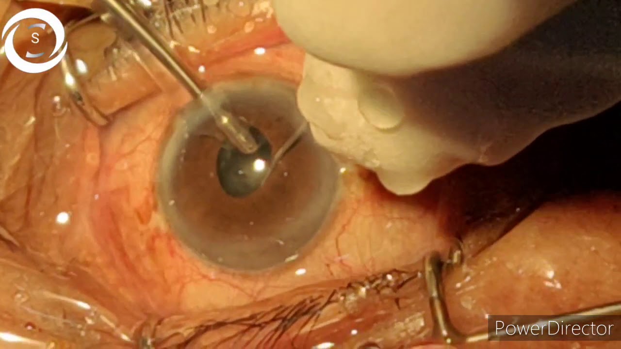 pinpoint pupils pinpoint pupils