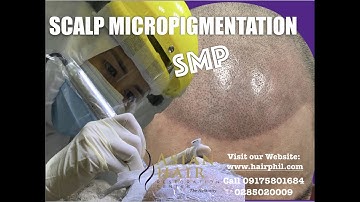 Scalp Micropigmentation SMP | Patient Review at Asian Hair Restoration Center & The Medical City