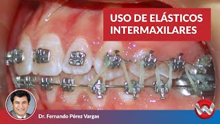 Uso de Elásticos Intermaxilares