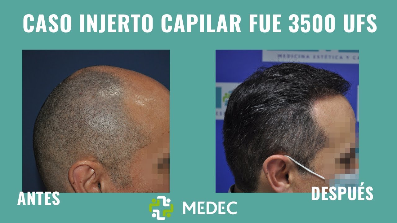 🙋‍‍CASO REAL de Injerto Capilar - 3.500 UFS - Resultados increíbles 👏‍‍