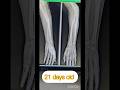 Malunited forearm fracture treated with osteoclasis and pop application