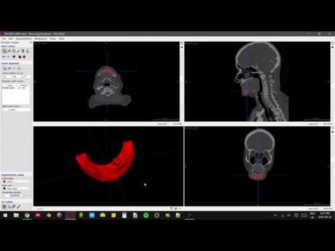 Patient CT Mandible Segmentation for 3D Print Tutorial [ITK-SNAP, Meshmixer, Makerbot]