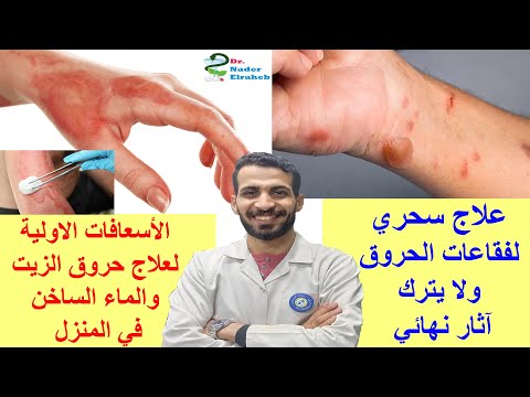 فيديو: علامات الحروق هي نتيجة كي غير لائق. كيف تتخلص منهم؟