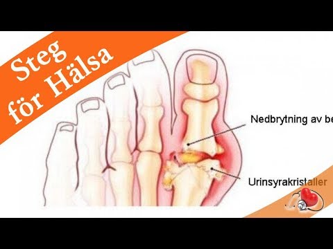 Video: Naturliga Behandlingar För Tendonit - Symtom, Orsaker Och Diettips