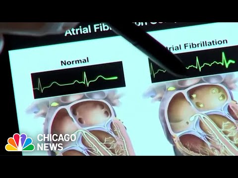 ●01)【同梱不可】心房細動の外科的治療/Surgical Treatment of Atrial Fibrillation/Jonathan Philpott/Academic Press/洋書/医学/医療/A ○01)【同梱不可】心房細動の外科的治療/Surgical Treatment of