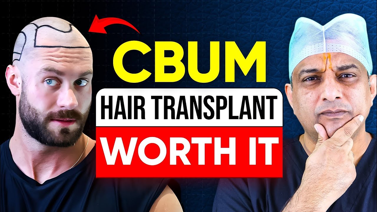 Chris Bumstead's Hair Transplant, Worth It ? Surgeon React YouTube
