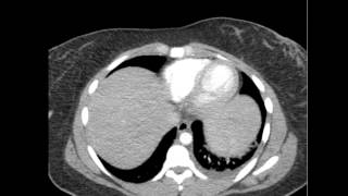CT 4 Cases Pyelonephritis and 1 Renal Abscess DISCUSSION by Radiologist