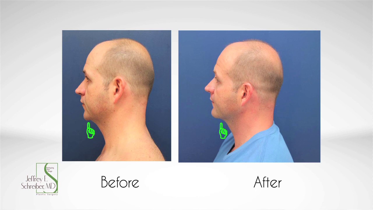 Baltimore Chin Implant Video by Plastic Surgery Expert, Dr. Jeffrey