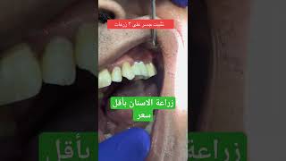 زراعة الاسنان#dentalimplant #dentist #dental #teeth #dentista #styleitaliano #dentistry