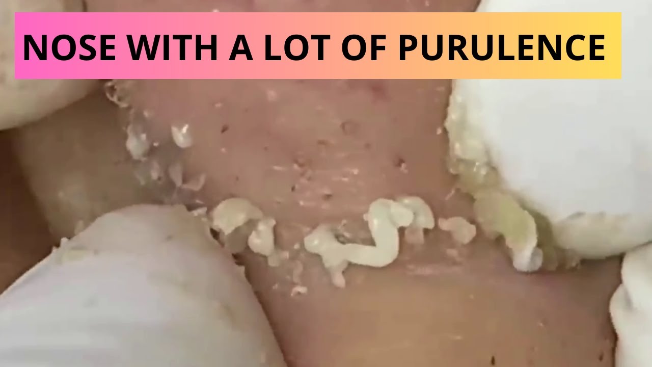 SATISFYING REMOVAL of BLACKHEAD SATISFACTORIA ELIMINACIÓN de PUNTOS