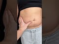 40代産後ママの脂肪吸引、綺麗にします