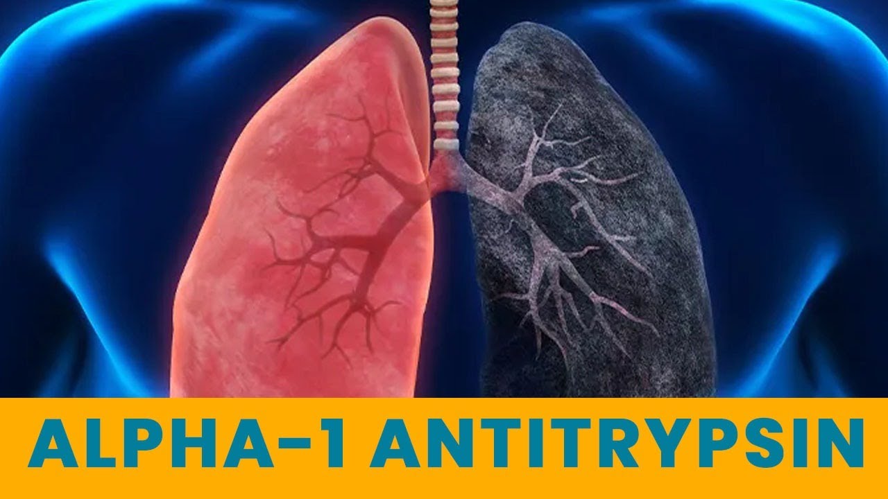 Alpha-1 Antitrypsin - Causes, Symptoms & Treatment | Dr.Nikhil Modi ...
