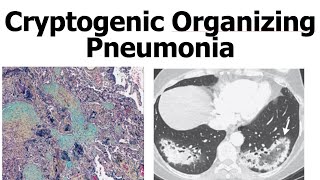 Cryptogenic Organizing Pneumonia (COP)