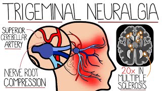Understanding Trigeminal Neuralgia by Rhesus Medicine 4,455 views 3 months ago 5 minutes, 58 seconds