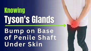 Knowing Tyson's Glands An Explanation of the Penile Shaft Bumps