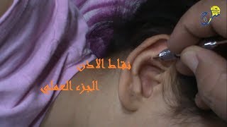 الابر الصينية في الاذن 2 الجزء العملي