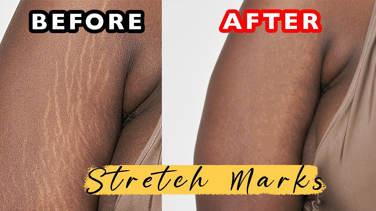 Removing Stretch Marks without Gym
