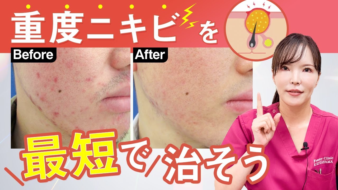 ニキビ 潰し た 後