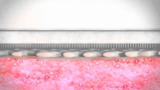 Pico Application - Skin Graft