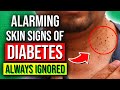 8 ALARMING Skin Signs Of Diabetes You Should NOT Ignore
