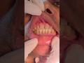 cementation of lower anterior bridge #dentist #prosthodontics #prosthesis #teeth