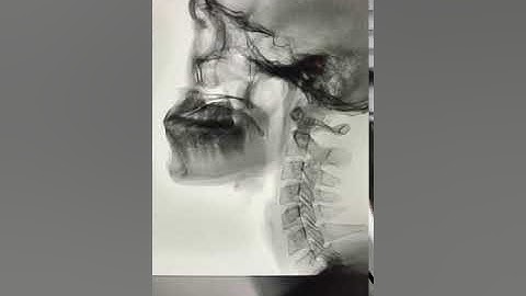 KIỂM TRA NUỐT BĂNG PHƯƠNG PHÁP VIDEO CẢN QUANG (VFSS)