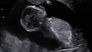 14 Weeks Ultrasound - Baby Boy Bouncing